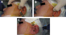 Technological Advances in Minimally Invasive TMJ Surgery Figure